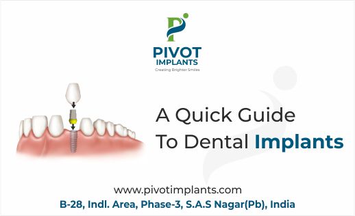 quick guide to dental implants