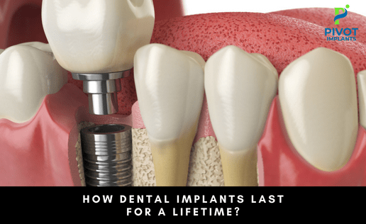 How Dental Implants Last For A Lifetime?