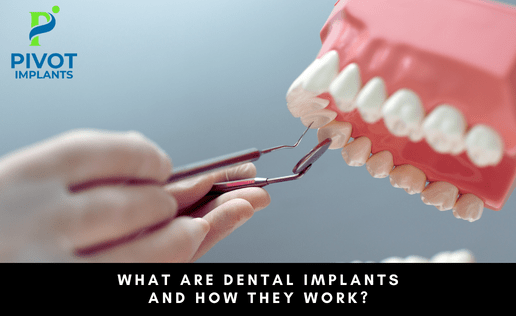 What Are Dental Implants And How They Work?