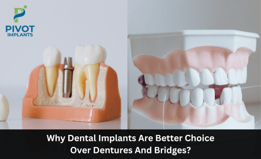 Why Dental Implants Are Better Choice Over Dentures And Bridges?