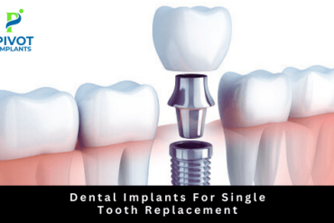 Dental Implants For Single Tooth Replacement