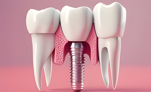 What Is The Right Size of Dental Implants?