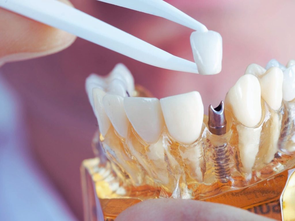 Dental Prosthetics